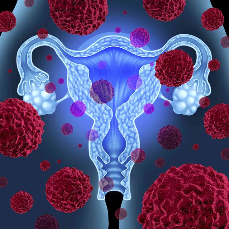 Uterine Cancer Screening
